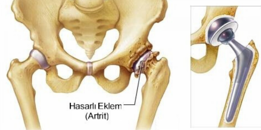 Knee and Hip Joint Prosthesis Operations