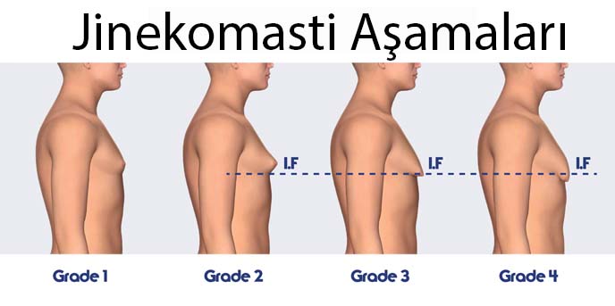 Causes of Breast Enlargement (Gynecomastia) in Men