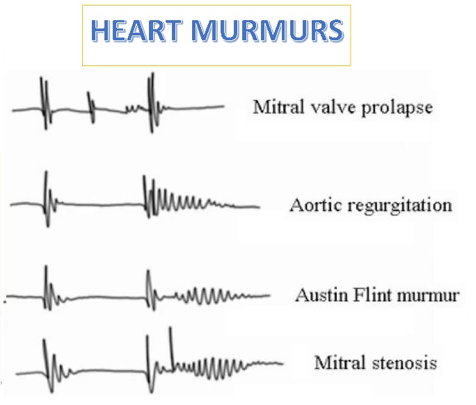 What is a Heart Murmur?