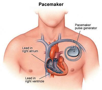 What is a Heart Battery (Pacemaker)?