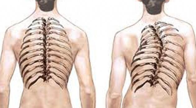 What is Scoliosis (Curvature of the Spine) ?