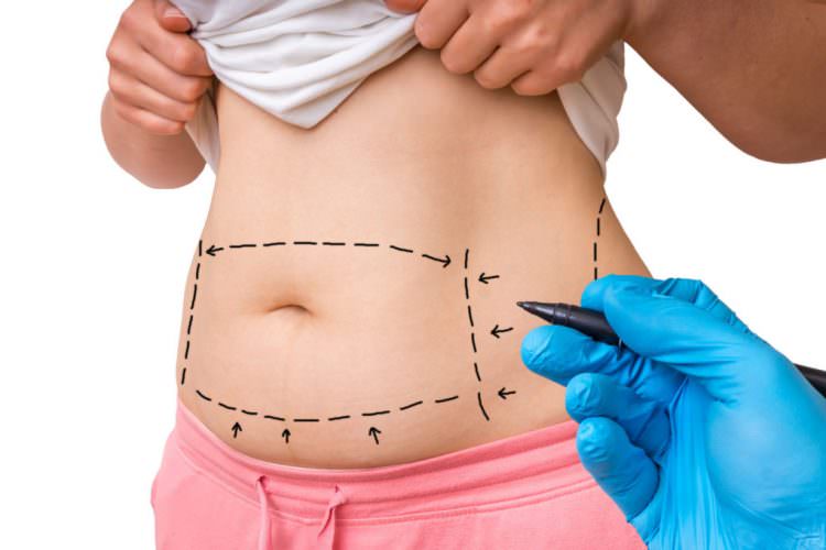 Tummy Tuck Surgery