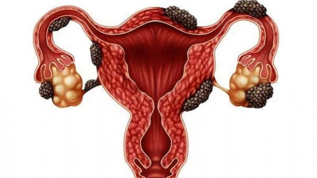 What is Endometriosis (Chocolate Cyst)? Istanbul Plastic Surgeon English