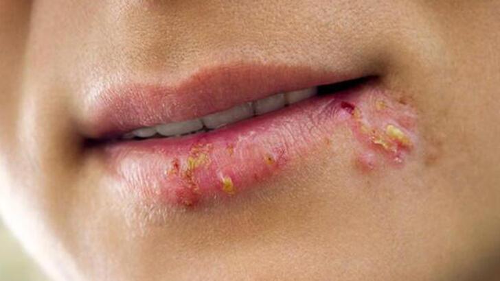 Why Herpes Occur