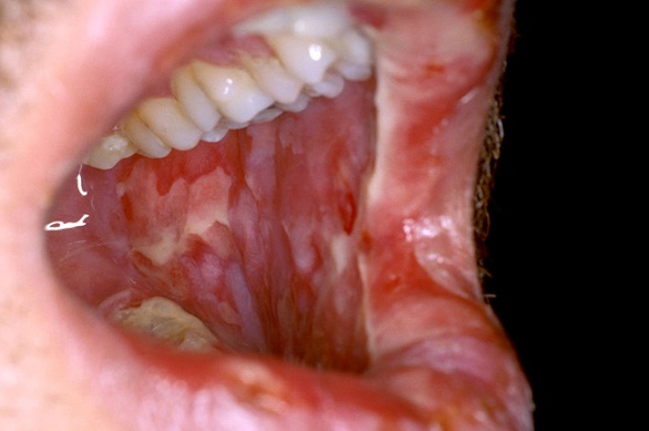 What You Should Know About Chemotherapy Mouth Wound