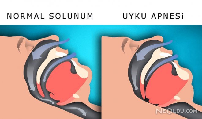 Airway Reconstruction Surgery